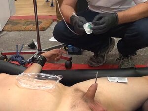 Instructions Vidéo infusion saline scrotale Texte anglais LONG