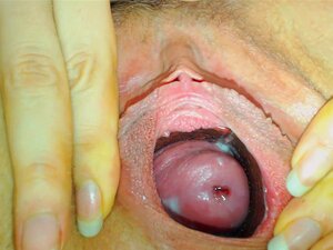 col de l'utérus timide